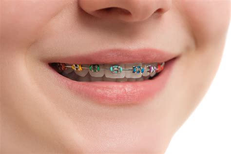 Making the Most of Your Braces